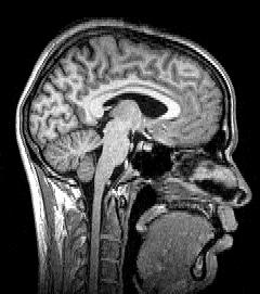 사람 뇌를 옆에서 촬영한 자기 공명 영상(MRI)